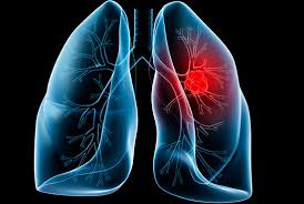 Gần 20.000 người tử vong mỗi năm vì ung thư phổi