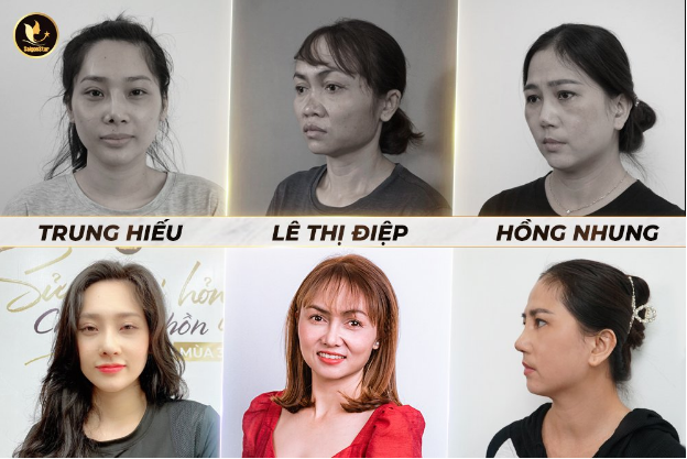 Những câu chuyện sửa mũi hỏng cảm động tại Thẩm mỹ viện Saigon Star - Ảnh 2.