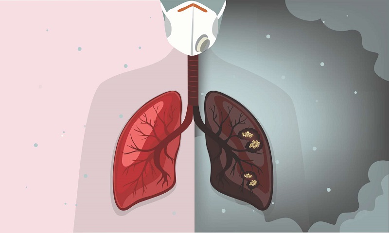 3 triệu chứng giống cảm lạnh có thể là bước đệm dẫn đến ung thư phổi, mong rằng bạn không nhầm lẫn - Ảnh 2.