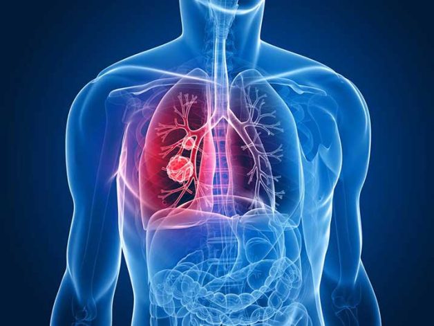 Không ốm sốt, chỉ đau thắt lưng, người phụ nữ đến BV Bạch Mai khám bất ngờ phát hiện ung thư phổi đã di căn: Cảnh báo 3 dấu hiệu quan trọng tuyệt đối không được bỏ qua - Ảnh 2.