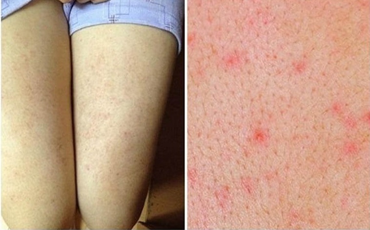 Viêm nang lông - Ảnh 1. Viêm nang lông - Ảnh 1.