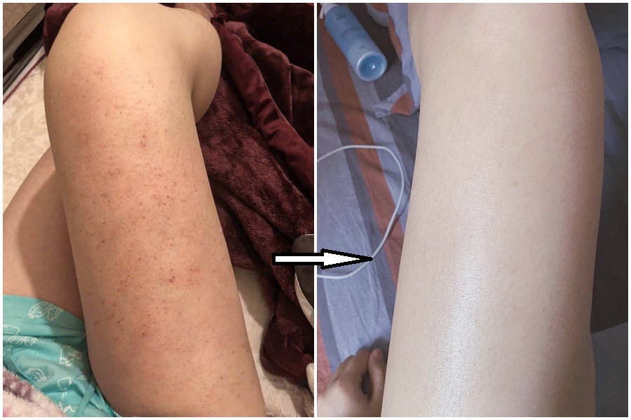 Viêm nang lông - Ảnh 2. Viêm nang lông - Ảnh 2.