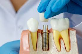 Trồng răng implant có gây đau hay xảy ra biến chứng? - Ảnh 3.