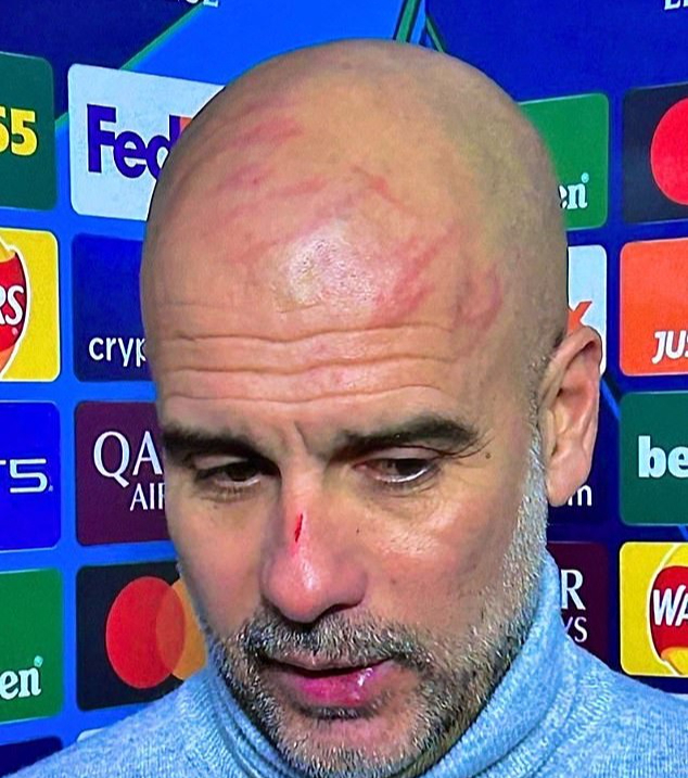 Bí ẩn đằng sau những vết thương gây chấn động của Pep Guardiola sau trận hòa Feyenoord - Ảnh 1.