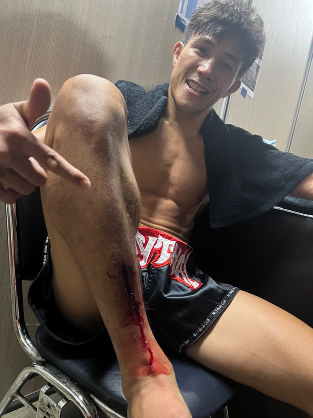 Nguyễn Trần Duy Nhất khoe vết thương phải khâu nhiều mũi sau chiến thắng thần đồng MMA, cộng đồng mạng khâm phục vì nỗ lực phi thường - Ảnh 2.