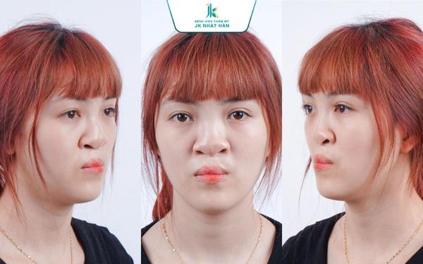 Bệnh viện JK Nhật Hàn giải cứu gương mặt cho cô gái sứt môi nặng - Ảnh 1.