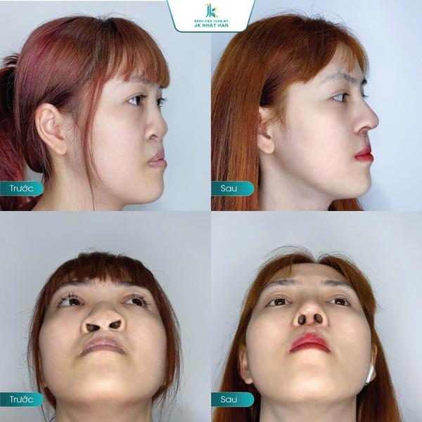 Bệnh viện JK Nhật Hàn giải cứu gương mặt cho cô gái sứt môi nặng - Ảnh 3.