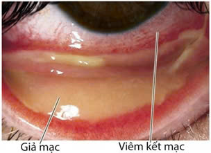 Viêm kết mạc và những câu hỏi thường gặp - Ảnh 1.