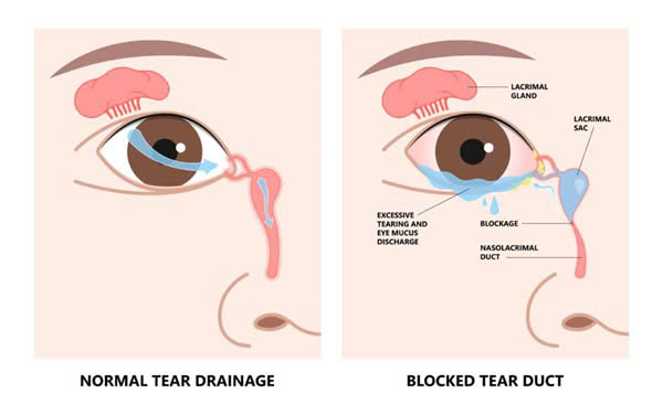 Tắc lệ đạo bẩm sinh - Ảnh 1.