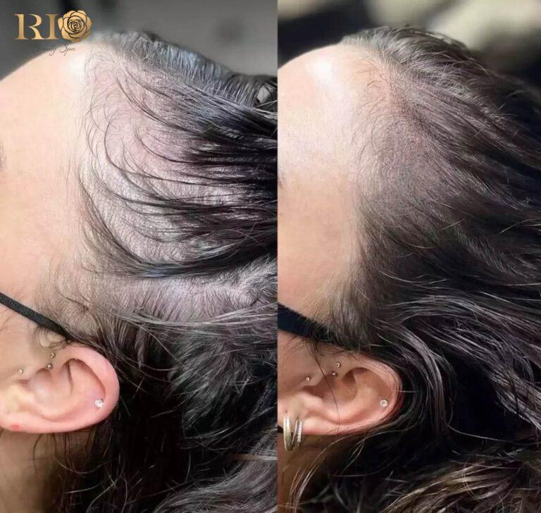 Xăm chân tóc - Cứu tinh cho mái tóc thưa, hói, thiếu tự tin - Ảnh 1.