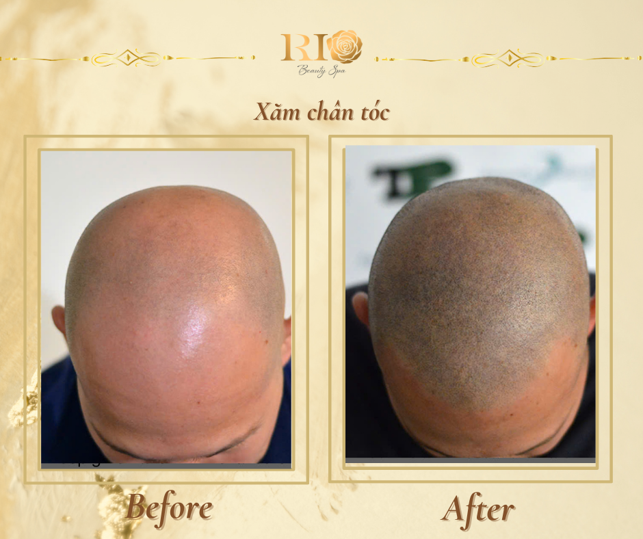 Xăm chân tóc - Cứu tinh cho mái tóc thưa, hói, thiếu tự tin - Ảnh 3.