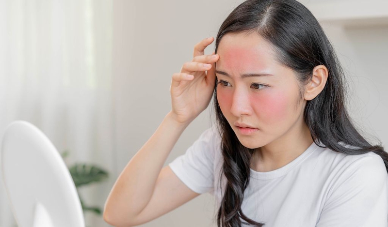 Sự thật về kem chống nắng và làn da mụn bạn cần biết - Ảnh 1.