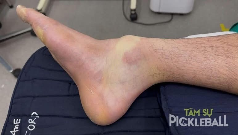 Choáng với hình ảnh cổ chân một thanh niên sau 4 giờ chơi pickleball liên tục - Ảnh 1. Choáng với hình ảnh cổ chân một thanh niên sau 4 giờ chơi pickleball liên tục - Ảnh 1.