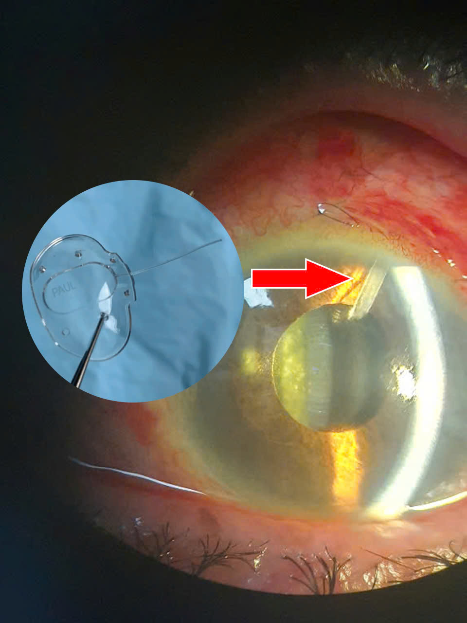 Đặt thành công Paul Valve thứ hai tại Việt Nam – Hy vọng mới cho bệnh nhân glaucoma - Ảnh 2.