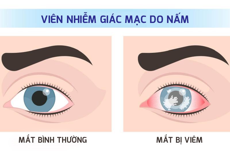 Viêm loét giác mạc do nấm - hiểm họa âm thầm có thể gây mù lòa - Ảnh 2.