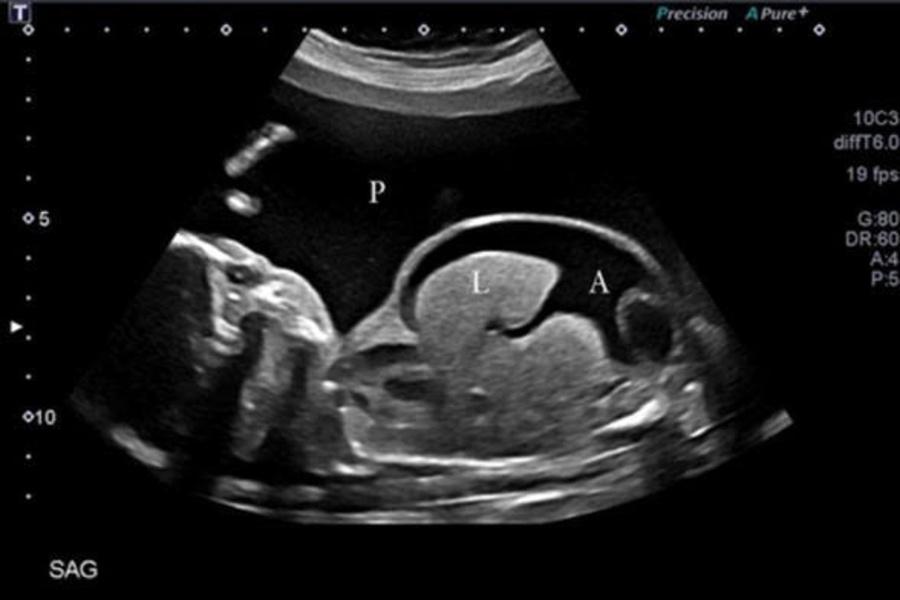 Truyền máu cho thai nhi qua dây rốn: Can thiệp kịp thời – Giữ trọn cơ hội sống cho thai nhi thiếu máu - Ảnh 1.