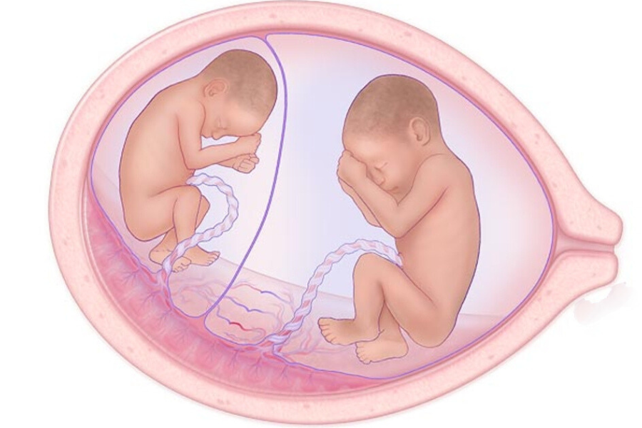 Can thiệp bào thai bằng kỹ thuật nội soi buồng ối đốt dây rốn bằng laser: Kỹ thuật tiên tiến chỉ định trong trường hợp nào? - Ảnh 1.