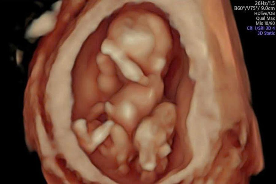 Can thiệp bào thai bằng kỹ thuật nội soi buồng ối đốt dây rốn bằng laser: Kỹ thuật tiên tiến chỉ định trong trường hợp nào? - Ảnh 2.