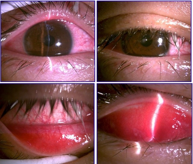 Tìm hiểu về bệnh đau mắt đỏ - Ảnh 1.