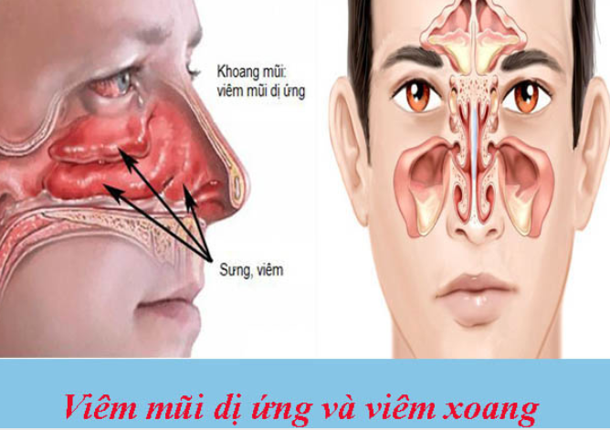 Thời tiết hè thất thường: Coi chừng nhầm lẫn giữa viêm mũi dị ứng và viêm xoang - Ảnh 1.