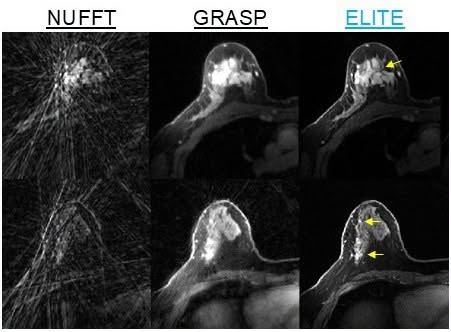 Trí tuệ nhân tạo: AI giúp tăng tốc chụp MRI phát hiện ung thư vú - Ảnh 1. Trí tuệ nhân tạo: AI giúp tăng tốc chụp MRI phát hiện ung thư vú - Ảnh 1.