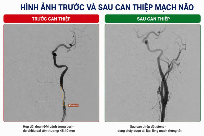 Nhồi máu não cấp sau khi chơi bóng đá do tổn thương động mạch cảnh - Ảnh 2.