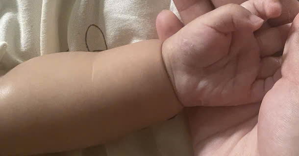 Trẻ 2 tháng tuổi mắc giang mai bẩm sinh do mẹ bỏ qua tầm soát thai kỳ - Ảnh 2.