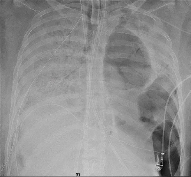 Trong ảnh: Phim chụp phổi bị xơ hóa của bệnh nhân mắc COVID-19 tại bệnh viện Northwestern Memorial ở Chicago, Mỹ. Ảnh: AFP/TTXVN