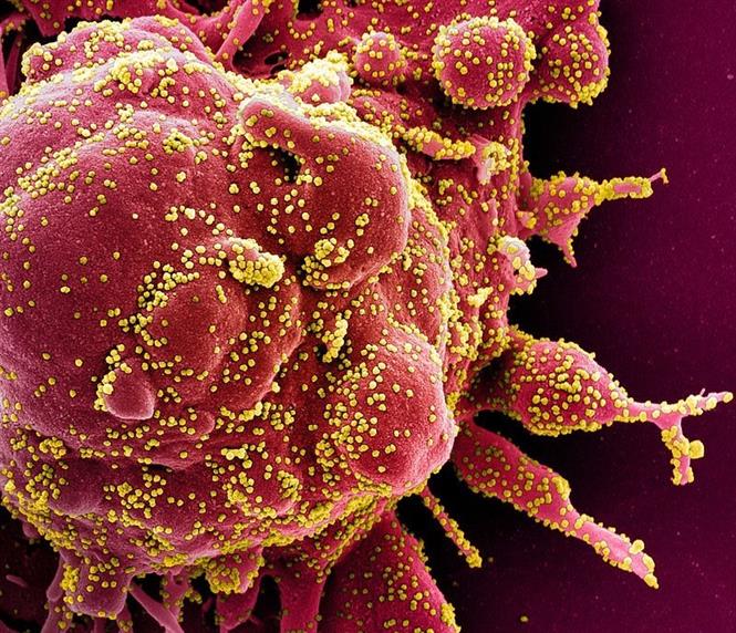 Hình ảnh quét qua kính hiển vi điện tử cho thấy một tế bào (màu đỏ) bị virus SARS-COV-2 (màu vàng) xâm nhập, lấy từ mẫu bệnh phẩm của bệnh nhân COVID-19. Ảnh: AFP/ TTXVN