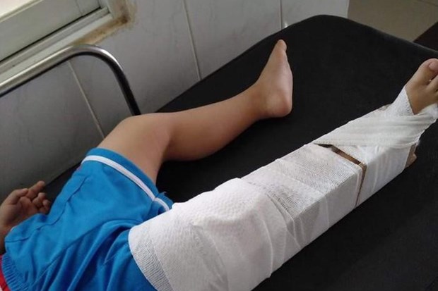 Kết quả chụp X-Quang cho thấy bé Đ.G.P bị gãy xương đùi