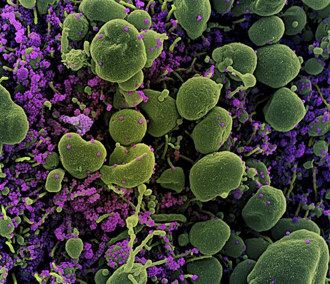 Trong ảnh: Hình ảnh quét qua kính hiển vi điện tử cho thấy một tế bào (màu xanh) bị virus SARS-COV-2 (màu tím) xâm nhập, lấy từ mẫu bệnh phẩm của bệnh nhân COVID-19 tại Viện Nghiên cứu Dị ứng và Bệnh Truyền nhiễm Quốc gia, Fort Detrick, Maryland, Mỹ ngày 15/7/2020. Ảnh: AFP/TTXVN