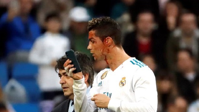 Máu chảy bê bết, Ronaldo vẫn thản nhiên dùng điện thoại để... soi gương