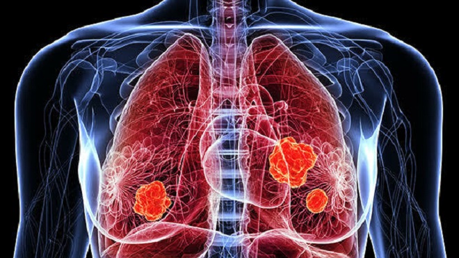 Ung thư phổi, phụ nữ, châu Á, tăng, ung thư