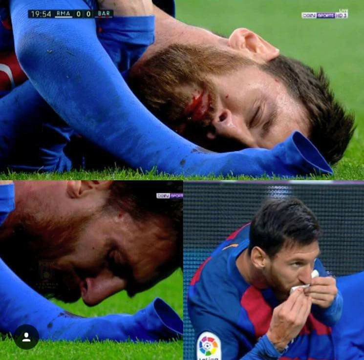 Messi chảy máu Real Madrid Barcelona