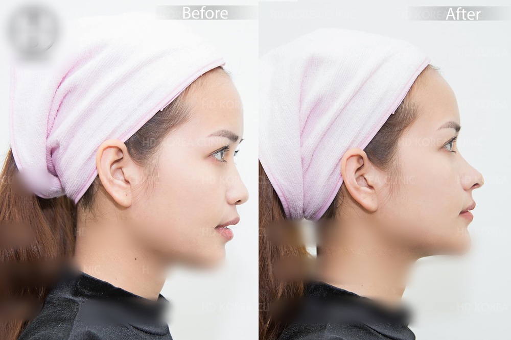 Từng khẳng định không có thời gian phẫu thuật thẩm mỹ, netizen bất ngờ khui ảnh Ngọc Châu can thiệp chỉnh sửa gương mặt - Ảnh 2.