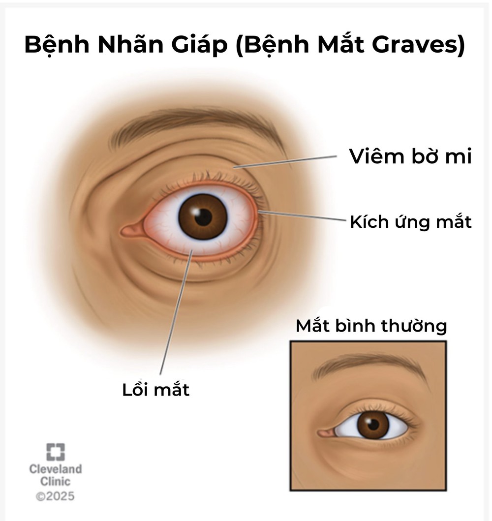 Bệnh lý nhãn giáp (bệnh mắt do Graves): Triệu chứng và Nguyên nhân - Ảnh 1.
