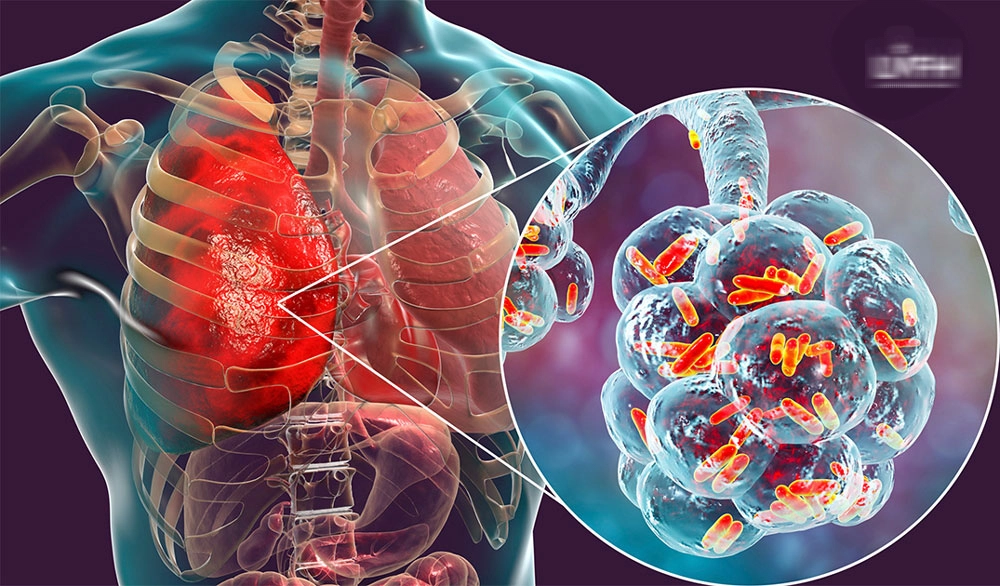 Cảnh báo nguy cơ mắc ung thư phổi gia tăng ở nhóm không hút thuốc - Ảnh 1. Cảnh báo nguy cơ mắc ung thư phổi gia tăng ở nhóm không hút thuốc - Ảnh 1.