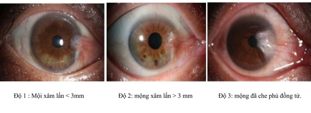 Những điều cần biết về bệnh mộng thịt - Ảnh 2. Những điều cần biết về bệnh mộng thịt - Ảnh 2.