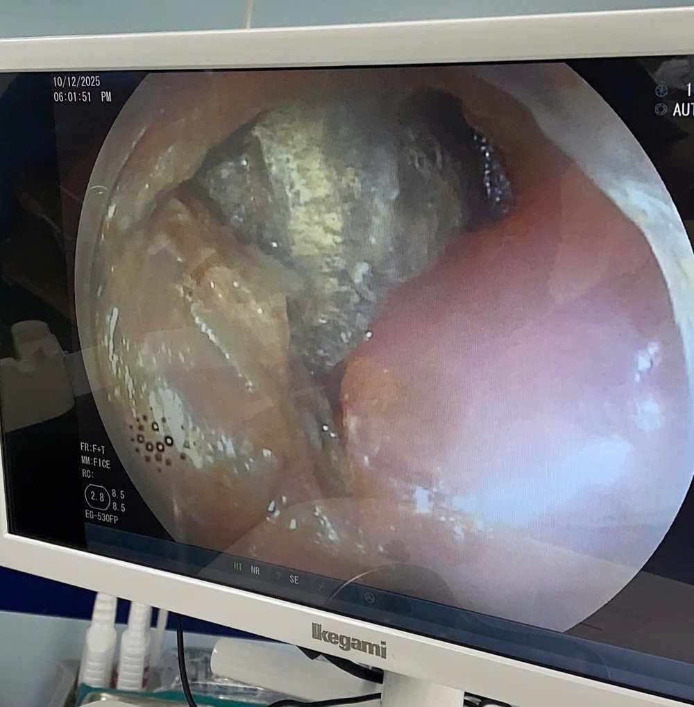 Cảnh báo nguy cơ từ pin cúc áo: Bé trai 2 tuổi suýt thủng thực quản - Ảnh 1. Cảnh báo nguy cơ từ pin cúc áo: Bé trai 2 tuổi suýt thủng thực quản - Ảnh 1.