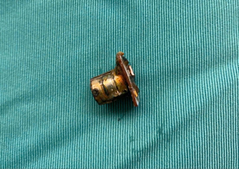 Cảnh báo nguy cơ từ pin cúc áo: Bé trai 2 tuổi suýt thủng thực quản - Ảnh 2. Cảnh báo nguy cơ từ pin cúc áo: Bé trai 2 tuổi suýt thủng thực quản - Ảnh 2.