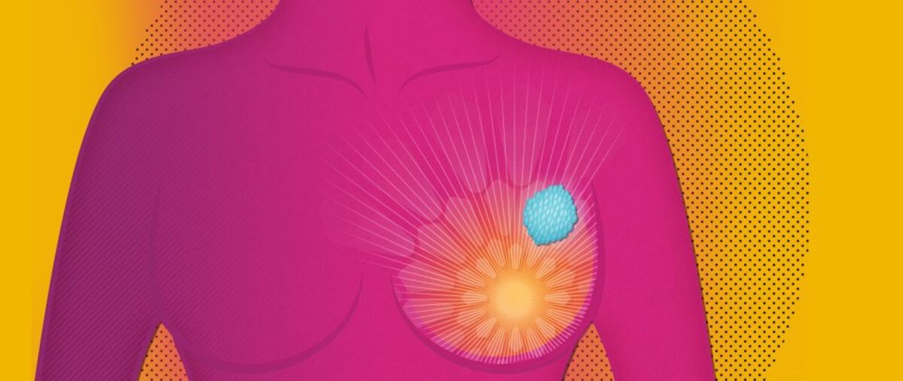 AstraZeneca công bố đột phá của thuốc điều trị ung thư vú - Ảnh 1.