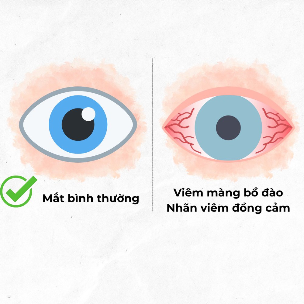 Bệnh lý nhãn viêm đồng cảm - Ảnh 1.
