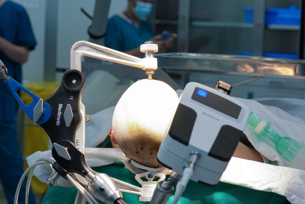 Vinmec tiên phong điều trị động kinh bằng Robot định vị thần kinh hàng đầu thế giới - Ảnh 1.