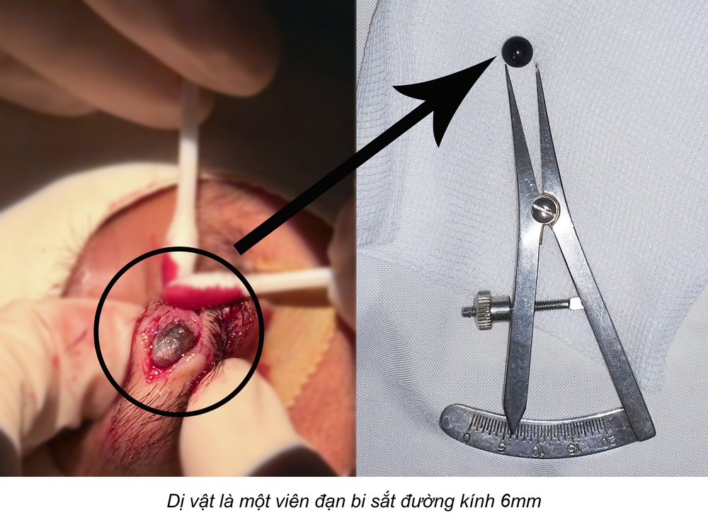 Nam sinh 15 tuổi mang viên bi sắt trong mí mắt suốt nhiều ngày - Ảnh 1.