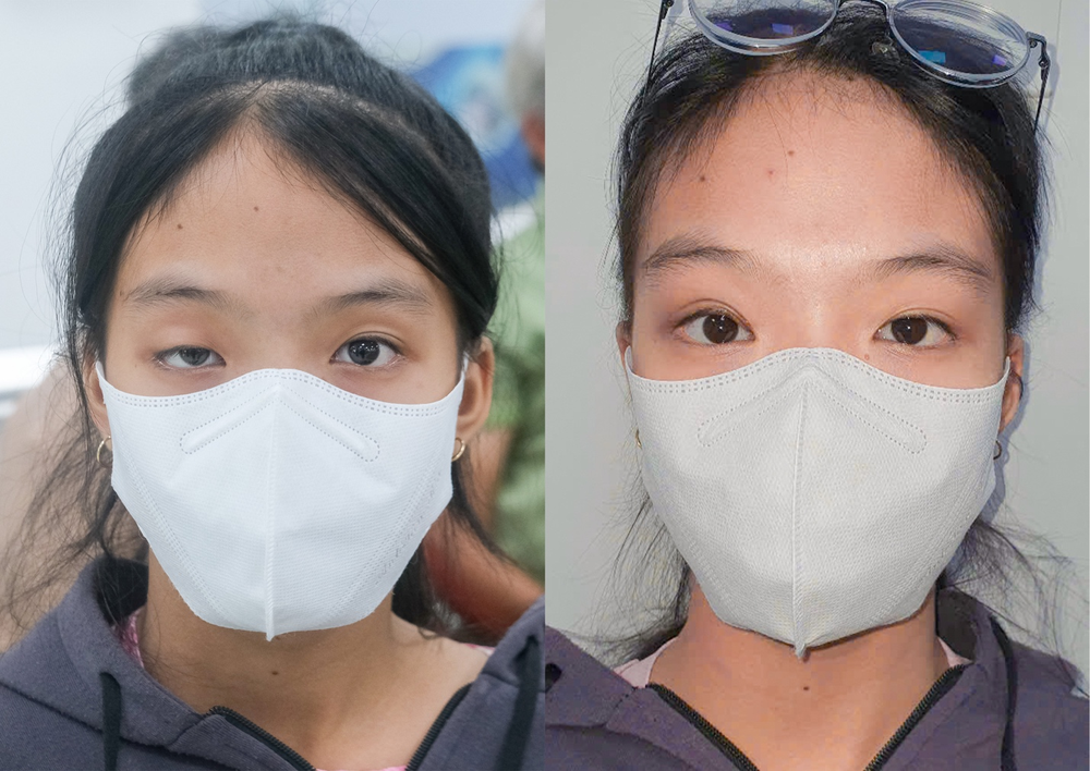 Phẫu thuật sụp mi bẩm sinh thành công, bé gái lấy lại ánh nhìn trước thềm lớp 9 - Ảnh 1.