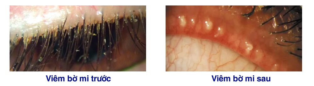 Bệnh lý viêm bờ mi - Ảnh 1.