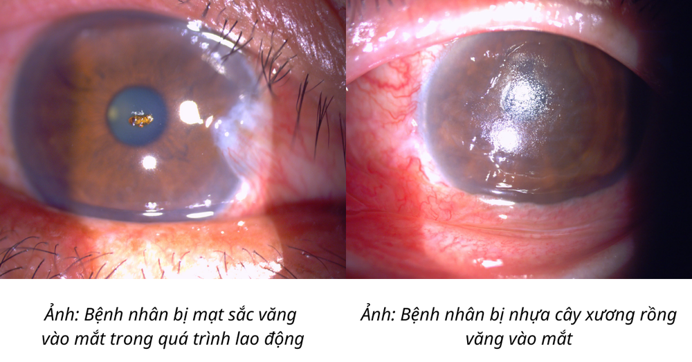 Cảnh báo chấn thương mắt trong lao động và sinh hoạt - Ảnh 1.