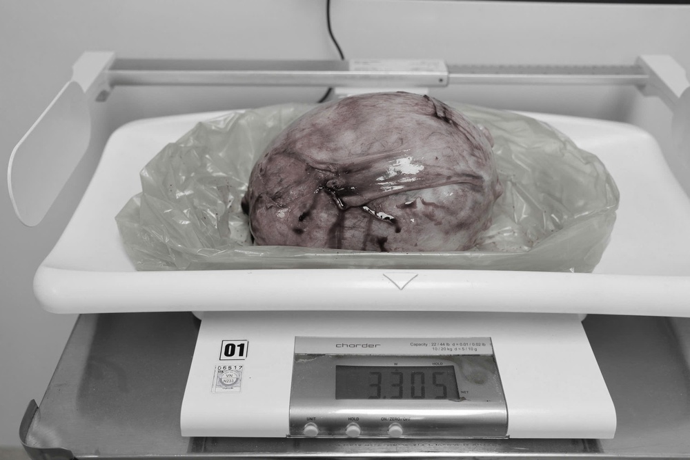 Phẫu thuật thành công khối u xơ tử cung “khổng lồ” 3,3kg kèm đa bệnh lý phức tạp - Ảnh 2.