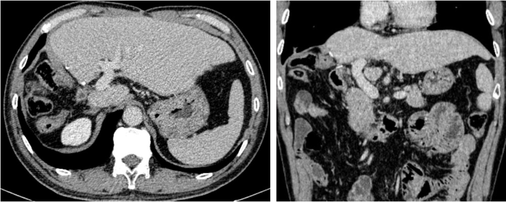 Kỳ tích sau 4 năm “thoát án tử” của bệnh nhân ung thư gan giai đoạn muộn - Ảnh 2.