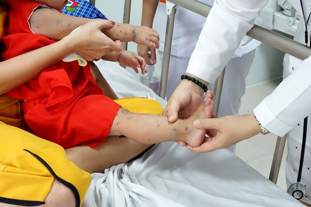 Hà Nội mở đợt cao điểm phòng chống bệnh tay chân miệng trong trường học - Ảnh 1.